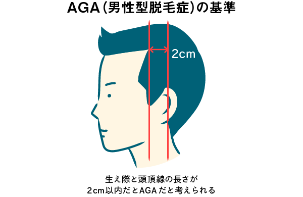 ＡＧＡ薄毛毎月4000円以下で発毛する方法教えます 髪が薄くて悩んでる方はご相談ください。発毛へ導きます！ イメージ1