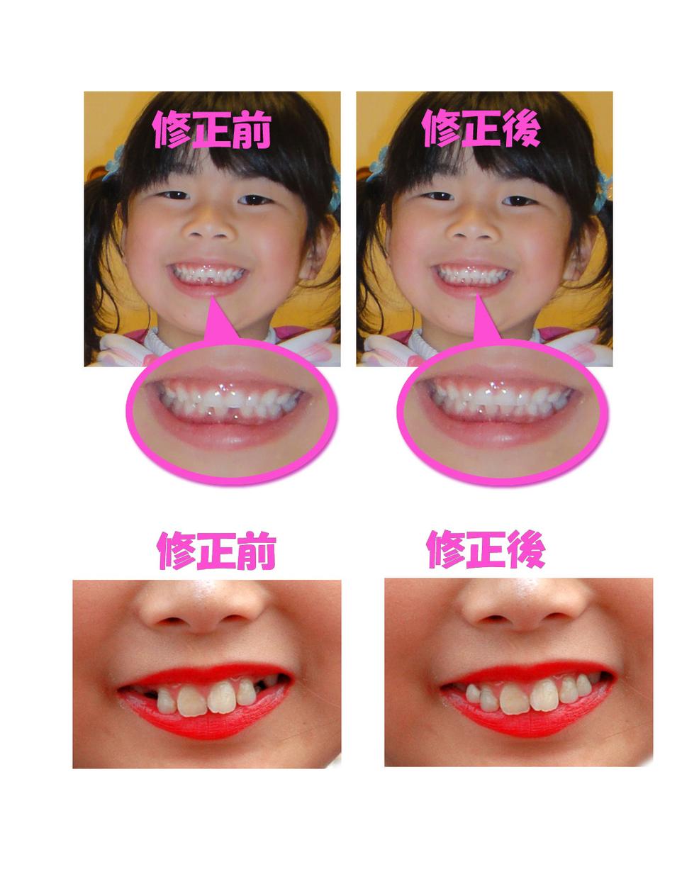 子供の歯のない写真を修整します。
