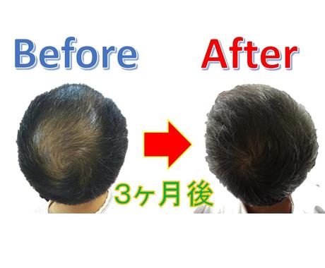 ハゲ薄毛をお金かけずに3ヶ月で改善した方法教えます クリニックに通わなくても まずは自力で改善努力できる実践法 ヘアケア ネイルの相談 ココナラ