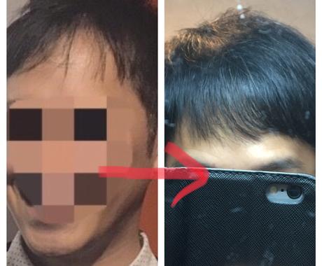 期間限定！30歳若ハゲの激安克服方法を教えます 若ハゲの悩みを持つ20代から40代の方へ