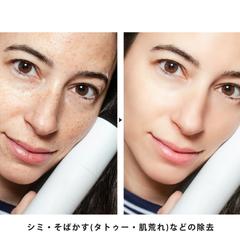 シミ・そばかすなどの除去レタッチ