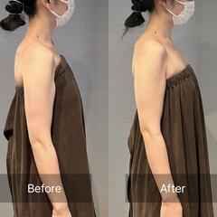 肩こり、巻き肩の施術変化