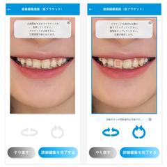 Braces simulator