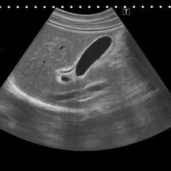 腹部超音波検査