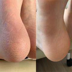 足裏、かかとのケア
