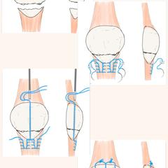 膝蓋骨(膝のお皿)の手術方法の一つのイラスト