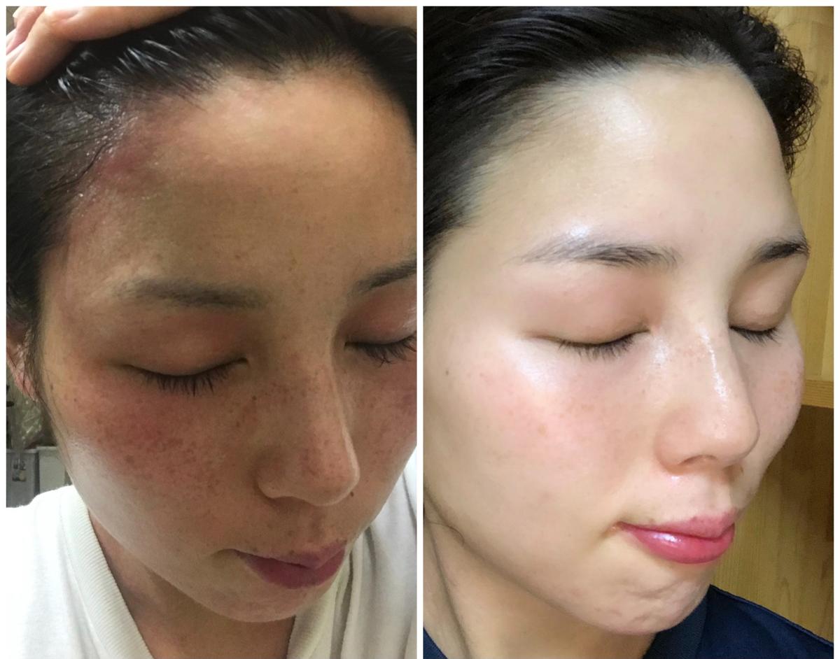 アトピーからの顔改善 お肌とダイエットのアドバイザー ゆきさん フリー美容アドバイザー のポートフォリオ ココナラ
